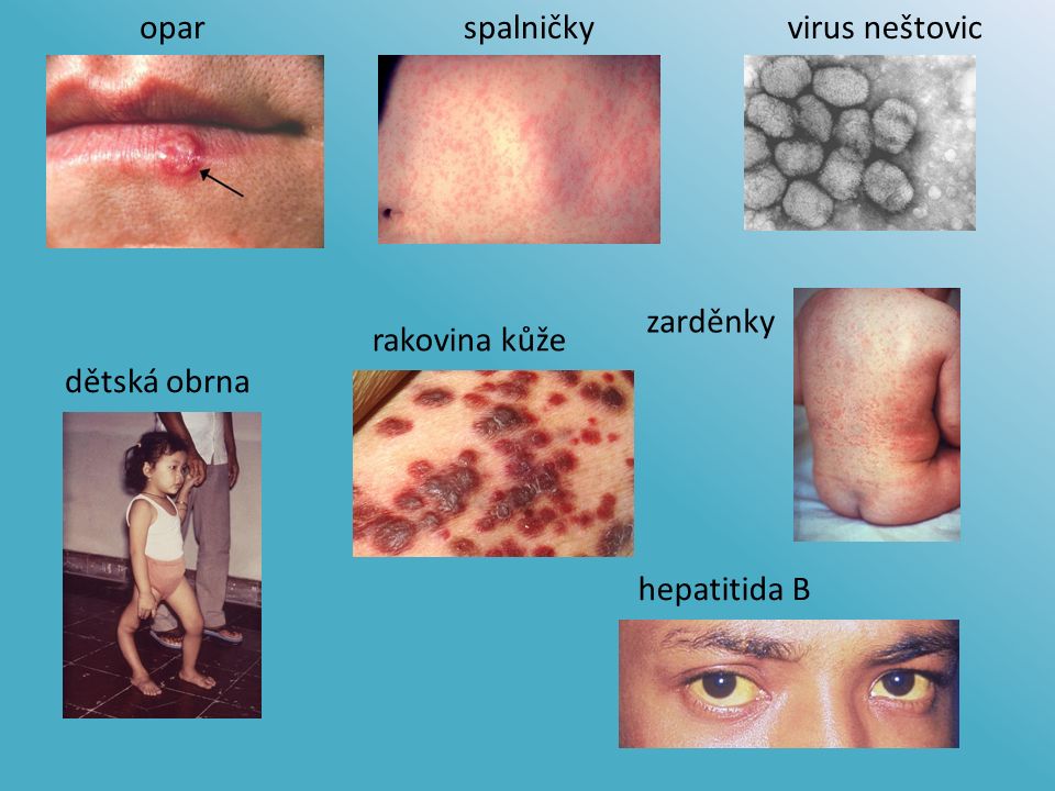 oparspalničkyvirus neštovic zarděnky hepatitida B dětská obrna rakovina kůže
