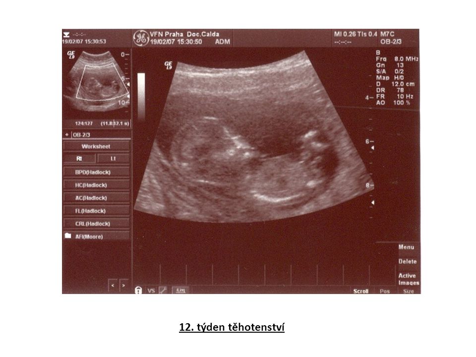 12. týden těhotenství