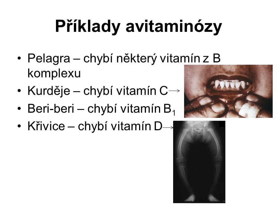 Pelagra – chybí některý vitamín z B komplexu Kurděje – chybí vitamín C Beri-beri – chybí vitamín B 1 Křivice – chybí vitamín D Příklady avitaminózy