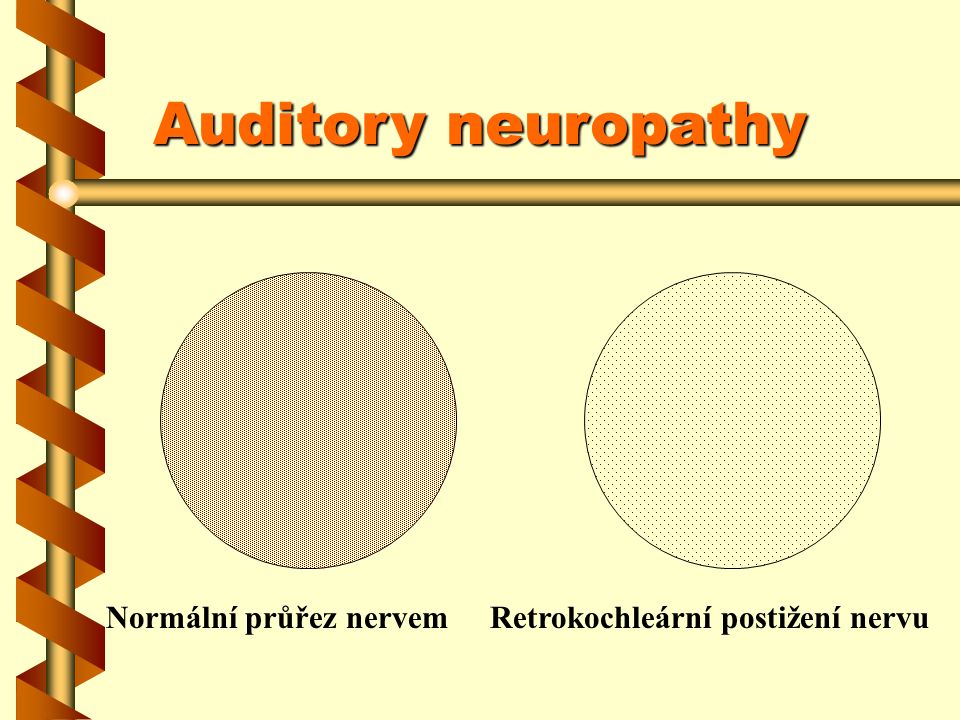Auditory neuropathy Normální průřez nervemRetrokochleární postižení nervu