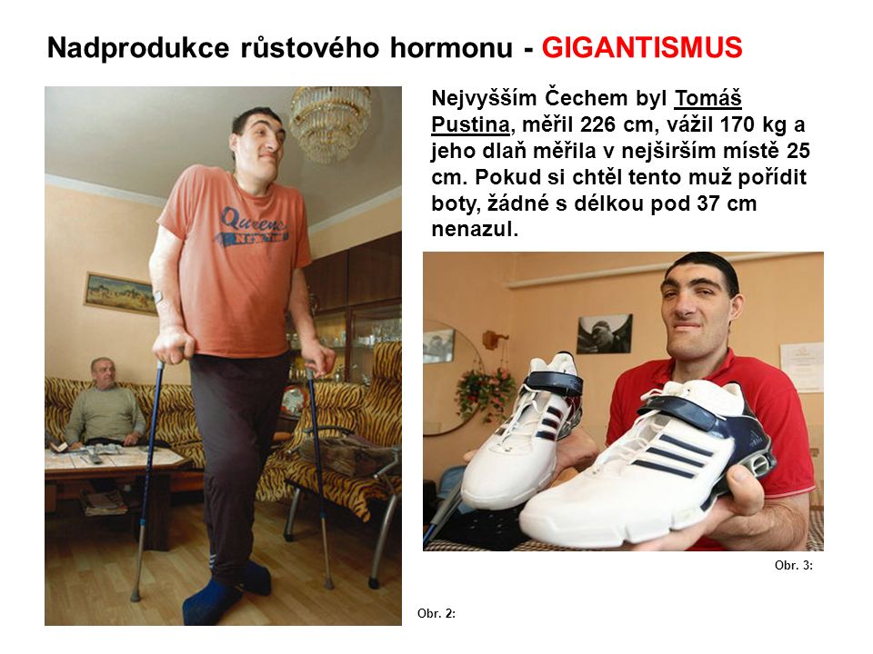 Nadprodukce růstového hormonu - GIGANTISMUS Nejvyšším Čechem byl Tomáš Pustina, měřil 226 cm, vážil 170 kg a jeho dlaň měřila v nejširším místě 25 cm.