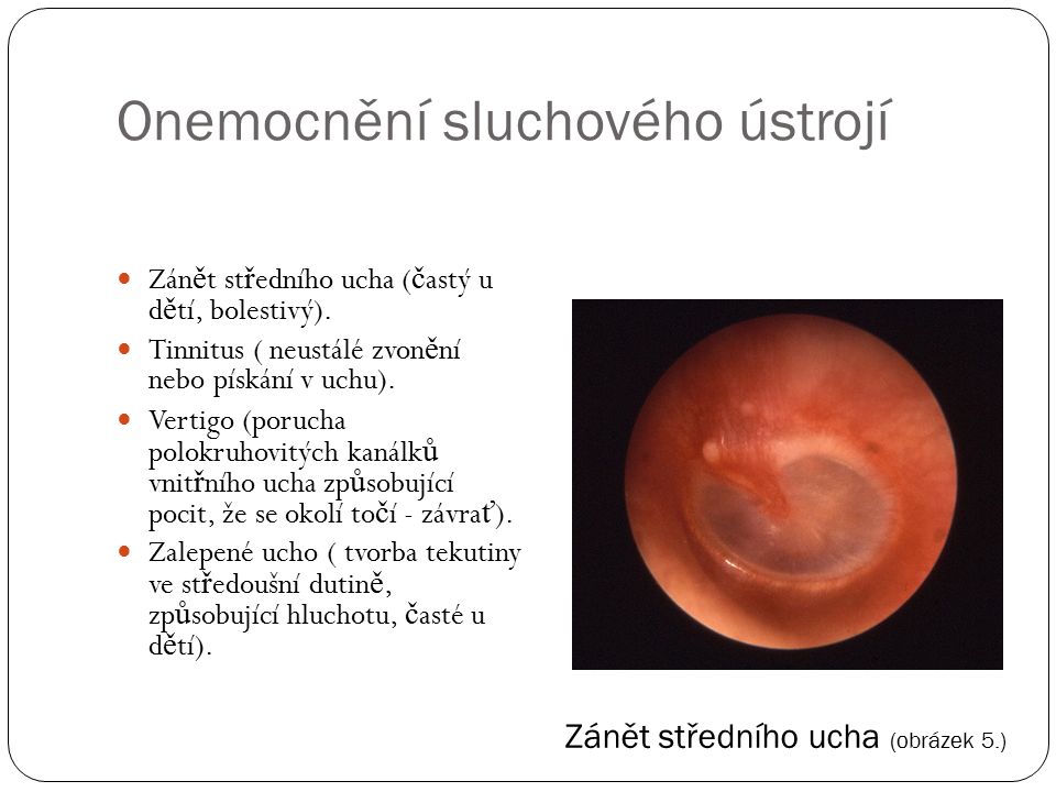 Onemocnění sluchového ústrojí Zánět středního ucha (obrázek 5.) Zán ě t st ř edního ucha ( č astý u d ě tí, bolestivý).